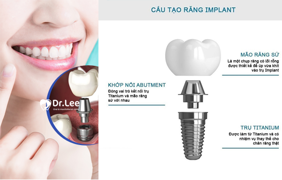 Cấy implant